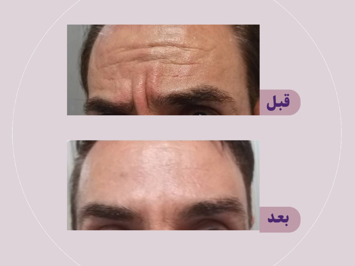 قبل و بعد تزریق بوتاکس پیشانی در کلینیک دکتر الهام سپندار