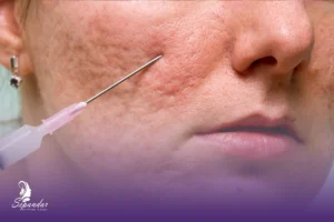 تزریق کلاژن برای جای جوش