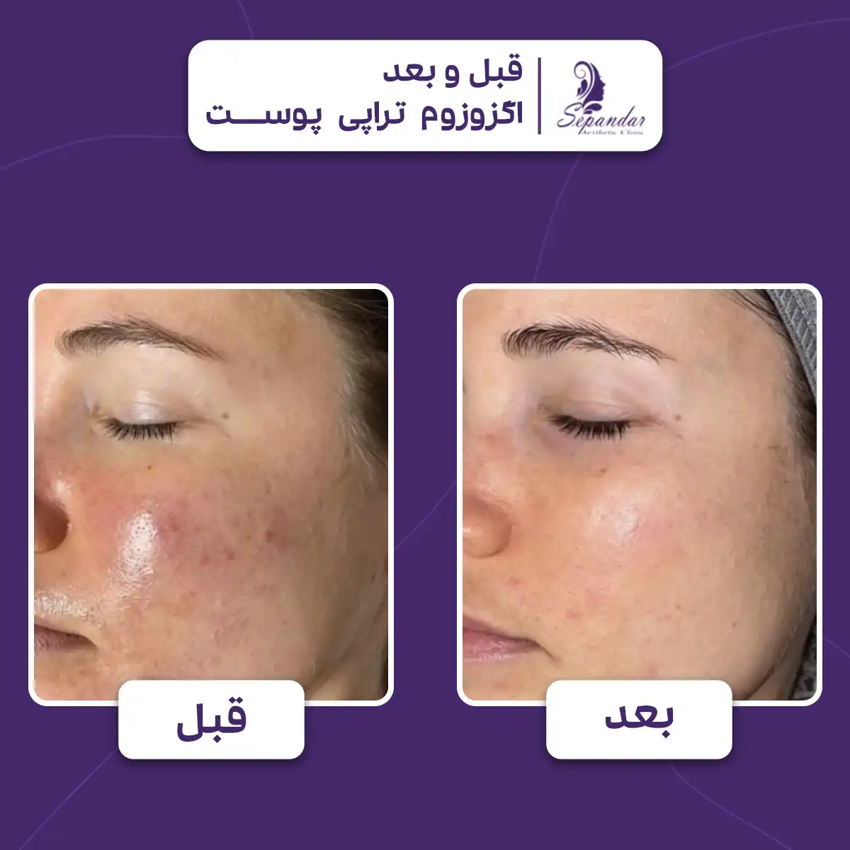 عکس قبل و بعد اگزوزوم تراپی برای از بین بردن جوشهای صورت