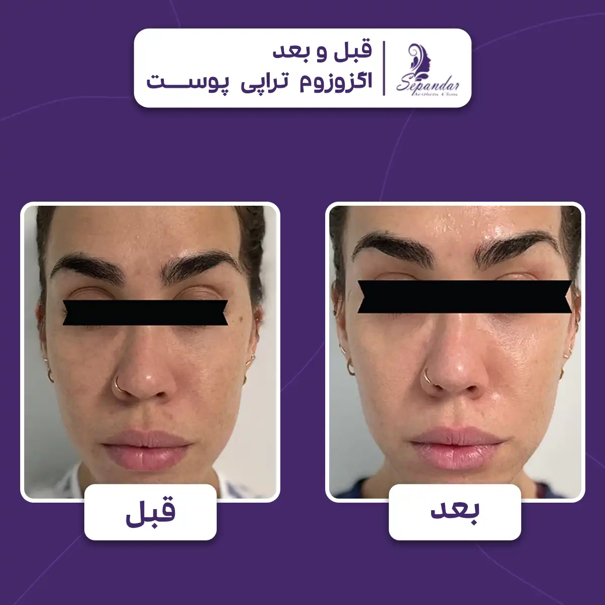 عکس قبل و بعد اگزوزوم تراپی برای از جوانسازی صورت