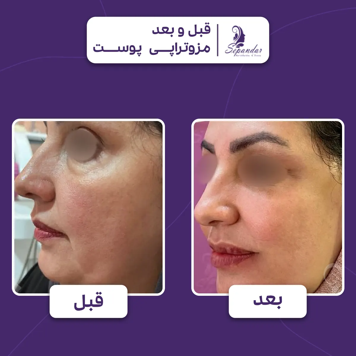 عکس از قبل و بعد مزوتراپی پوست