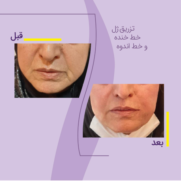 فرق بین فیلر و ژل که در نمونههای قبل و بعد تزریق مشخص است.