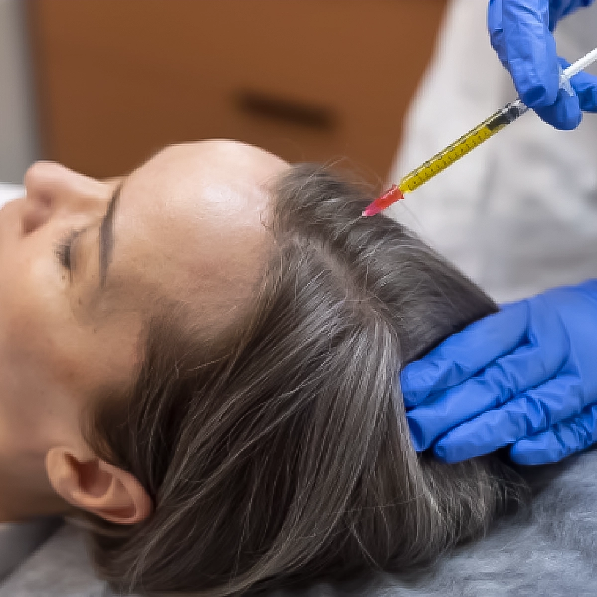 عکس از اگزوزوم تراپی مو و تزریق اگزوزوم ها به سر