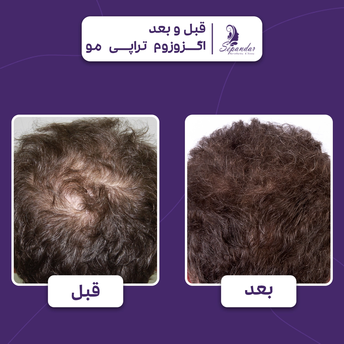 عکس از موهای یک فرد قبل و بعد از انجام اگزوزوم تراپی مو