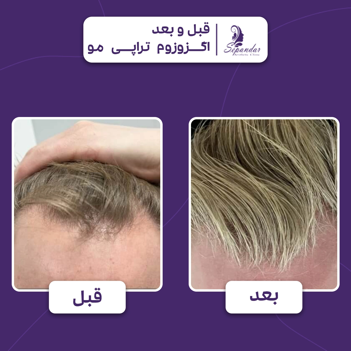 عکس از موهای یک فرد قبل و بعد از انجام اگزوزوم تراپی مو