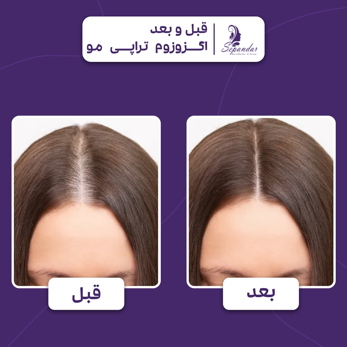 عکس از موهای سر یک خانم قبل و بعد از اگزوزوم تراپی مو