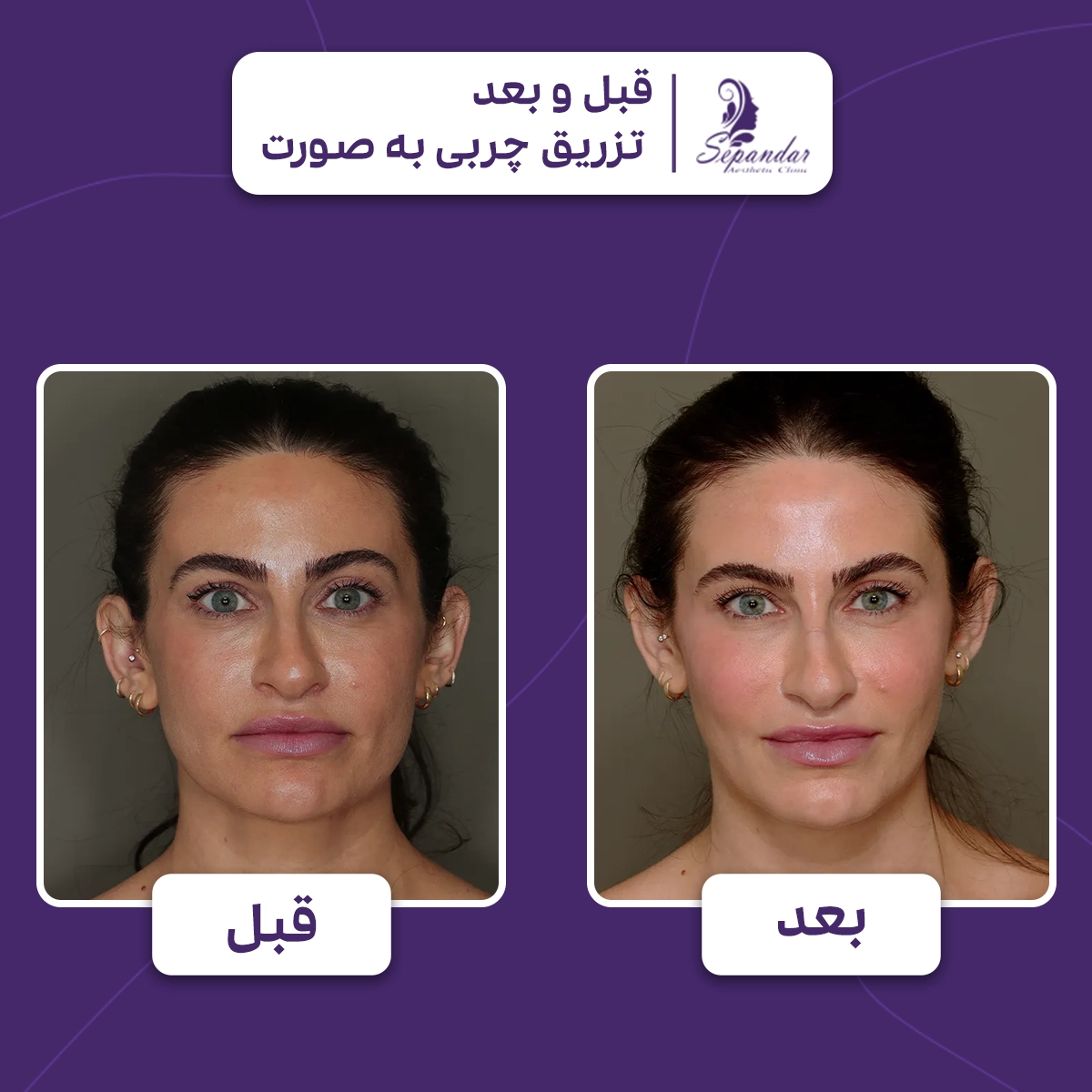 یک فرد قبل از تزریق چربی به صورت و بعد از تزریق چربی