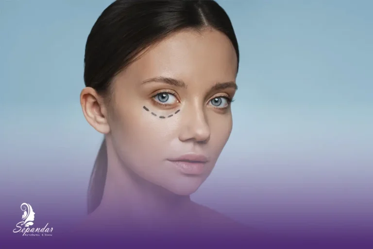 صورت یک خانم که زیر چشمش خط نقطه چین کشیده شده و محل انجام اگزوزوم زیر چشم را مشخص کرده است