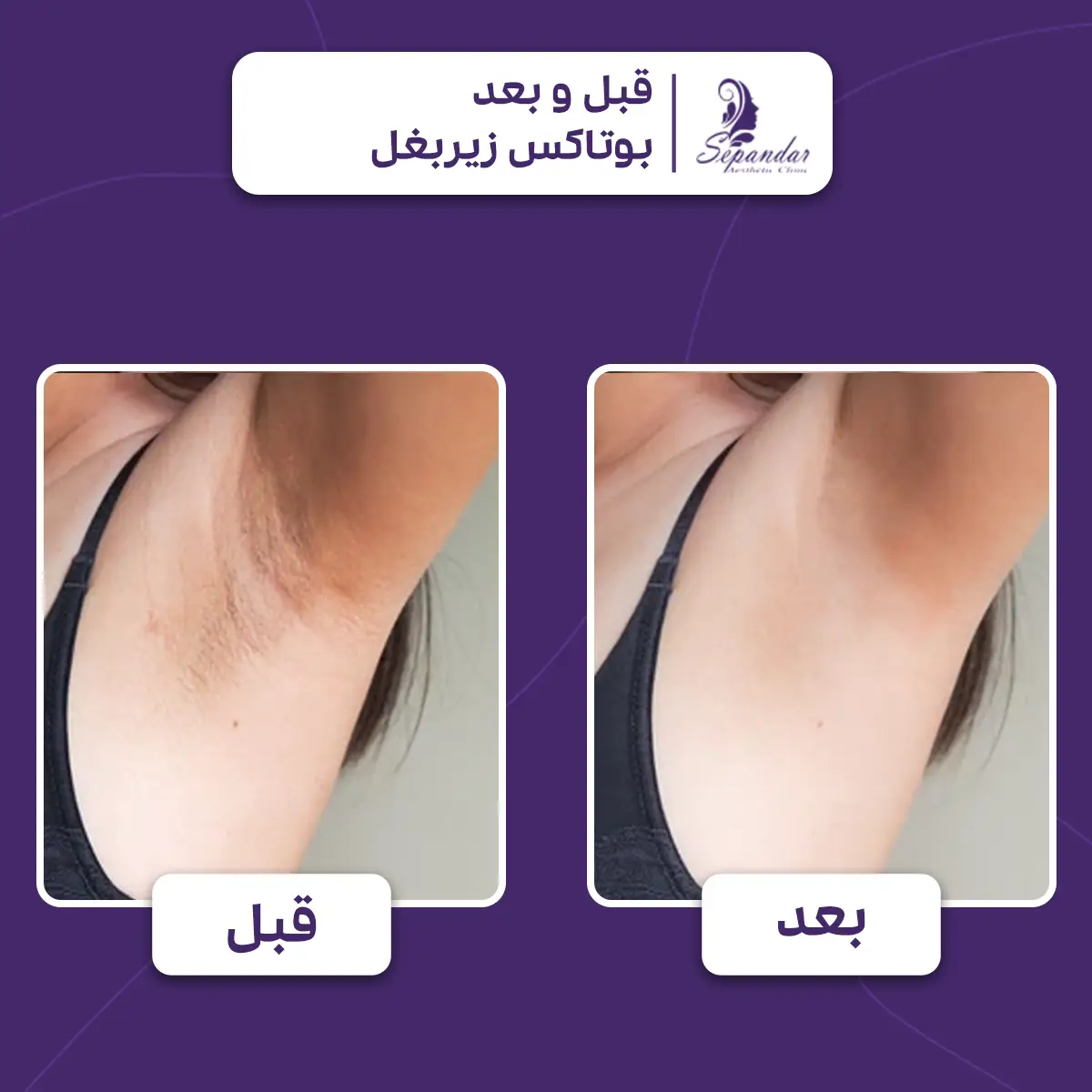 دو عکس کنار هم یکی از قبل از تزریق بوتاکس زیر بغل و یکی بعد از تزریق بوتاکس زیر بغل. بعد از تزریق بوتاکس تیرگی زیر بغل رفع شده است.