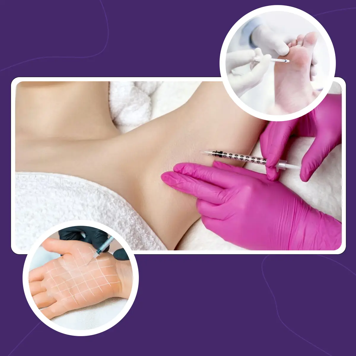 تزریق کردن بوتاکس به زیر بغل، کف دست و کف پا برای درمان تعریق بیش از حد