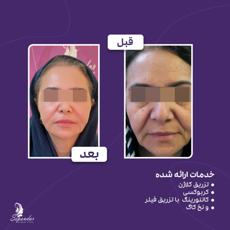 تزریق کلاژن، کربوکسی تراپی، کانتورینگ با فیلر