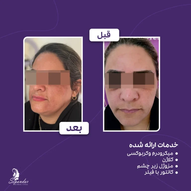 میکرودرم، کربوکسی، تزریق کلاژن، مزوژل، کانتور با فیلر