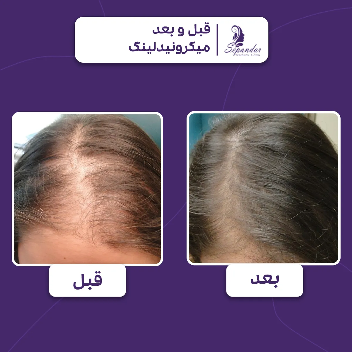 دو عکس از موهای سر یک خانم که یکی قبل از انجام مزونیدلینگ برای موهایش است و دیگری بعد از درمان مزونیدلینگ