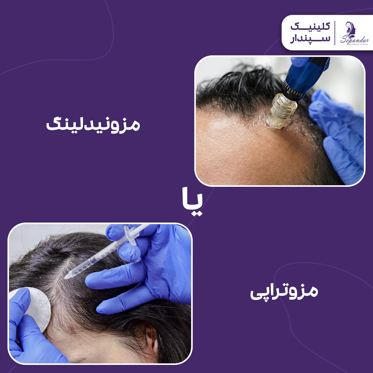 تصویر مزونیدلینگ و مزوتراپی مو در کنار هم که هر دو از روش های محبوب برای درمان ریزش مو و رشد مجدد آنها هستند اما تفاوت هایی باهم نیز دارند