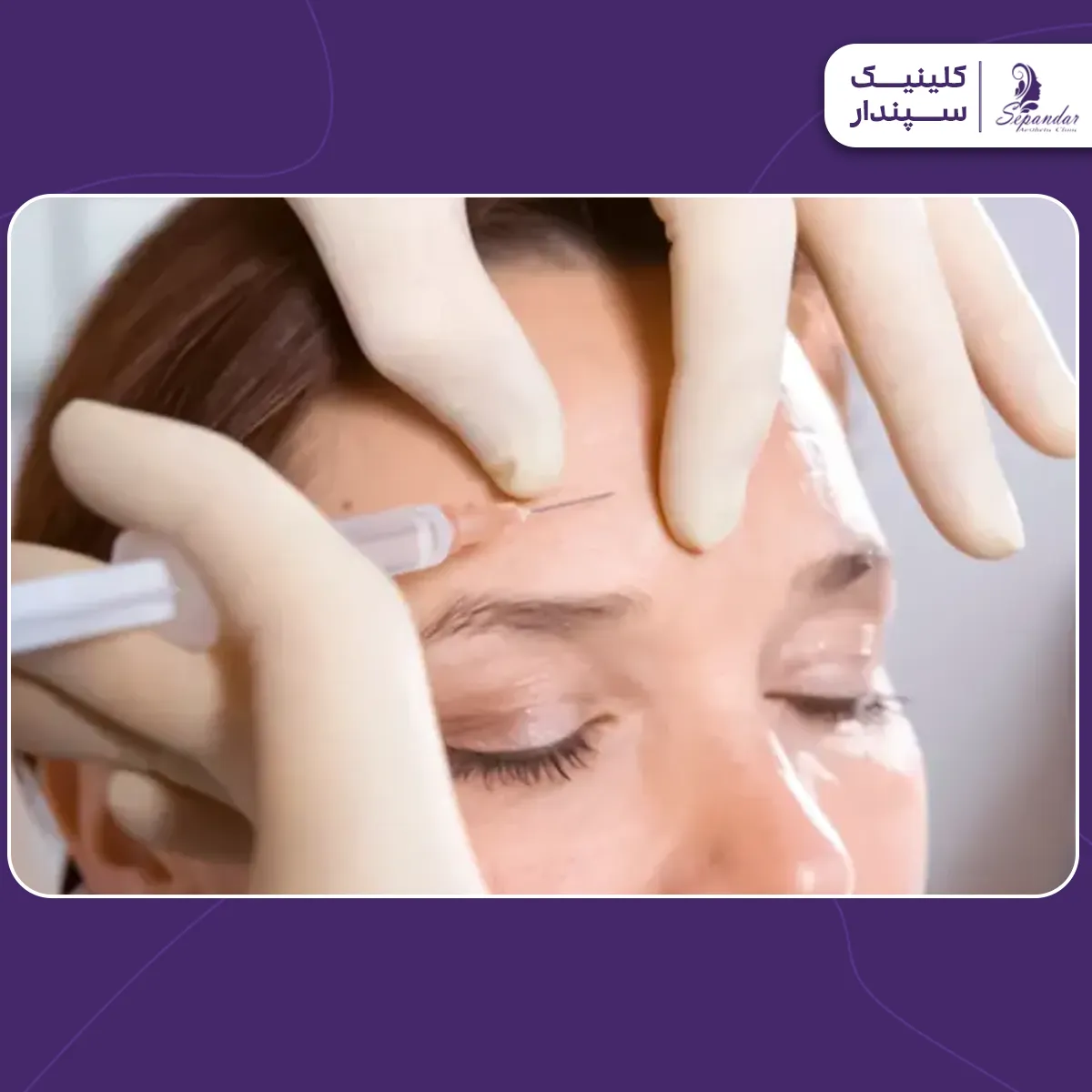 فردی که در حال تزریق بوتاکس مصپورت به پیشانی اش است