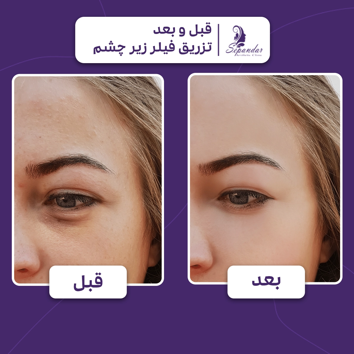 عکس قبل و بعد از تزریق ژل زیر چشم