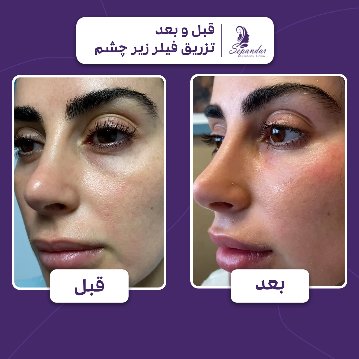 عکس قبل و بعد از تزریق ژل زیر چشم