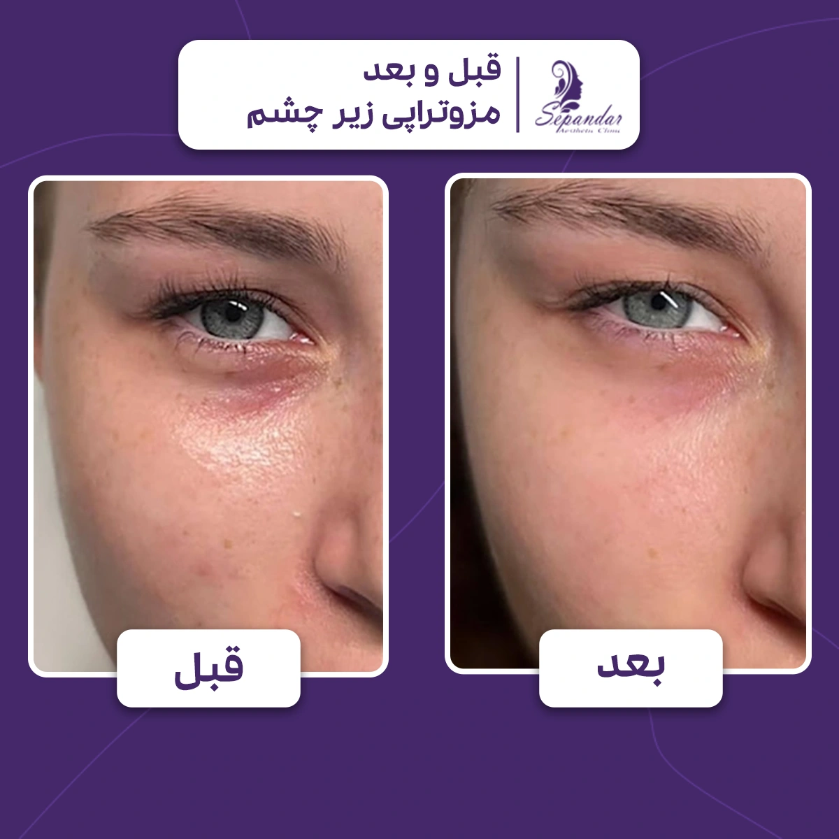 عکس قبل و بعد مزوتراپی زیر چشم یک خانم که بعد از مزوتراپی چروک های ریز و پف و تیرگی دور چشم کمتر شده است