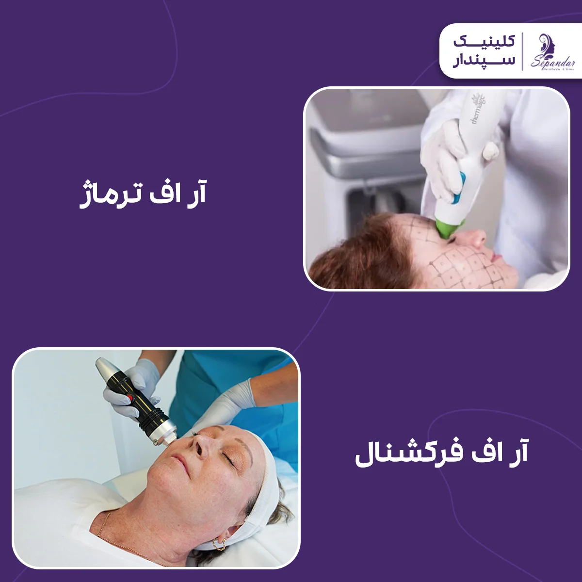 تصویری از دو روش آر اف ترماژ و آر اف فرکشنال در کنار یکدیگر که مقایسه این دو روش جوانساز را نشان میدهد