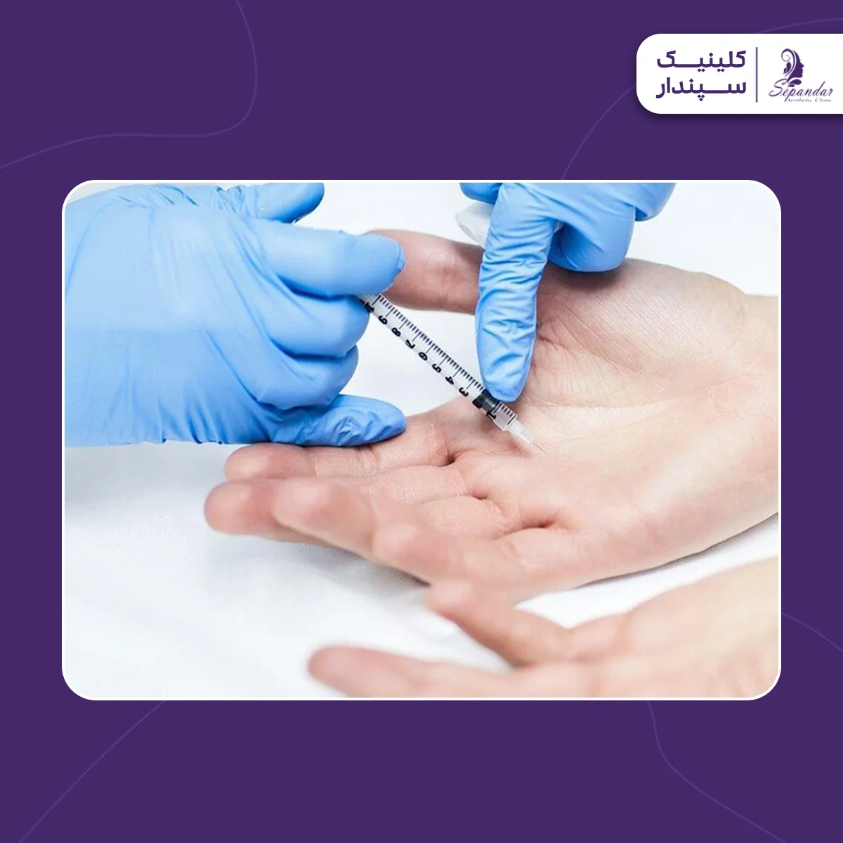 فردی که در حال تزریق بوتاکس کف دست برای جلوگیری از عرق کردن دست است