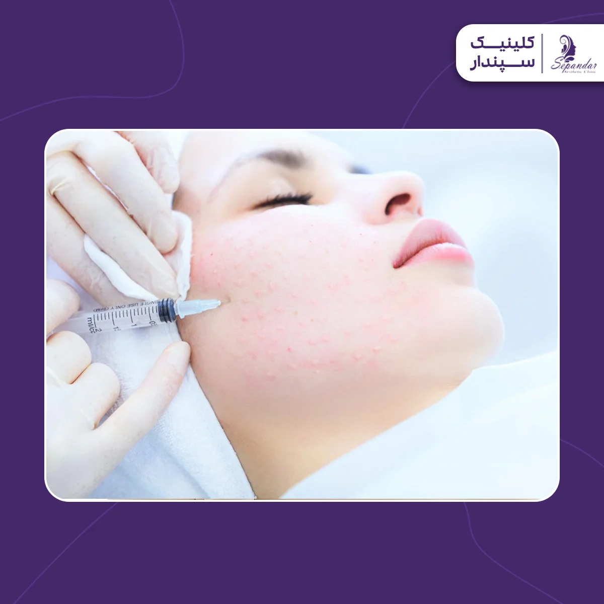 خانمی در حال انجام مزوتراپی صورت که به مراقبت های بعد از مزوتراپی صورت نیز فکر می کند