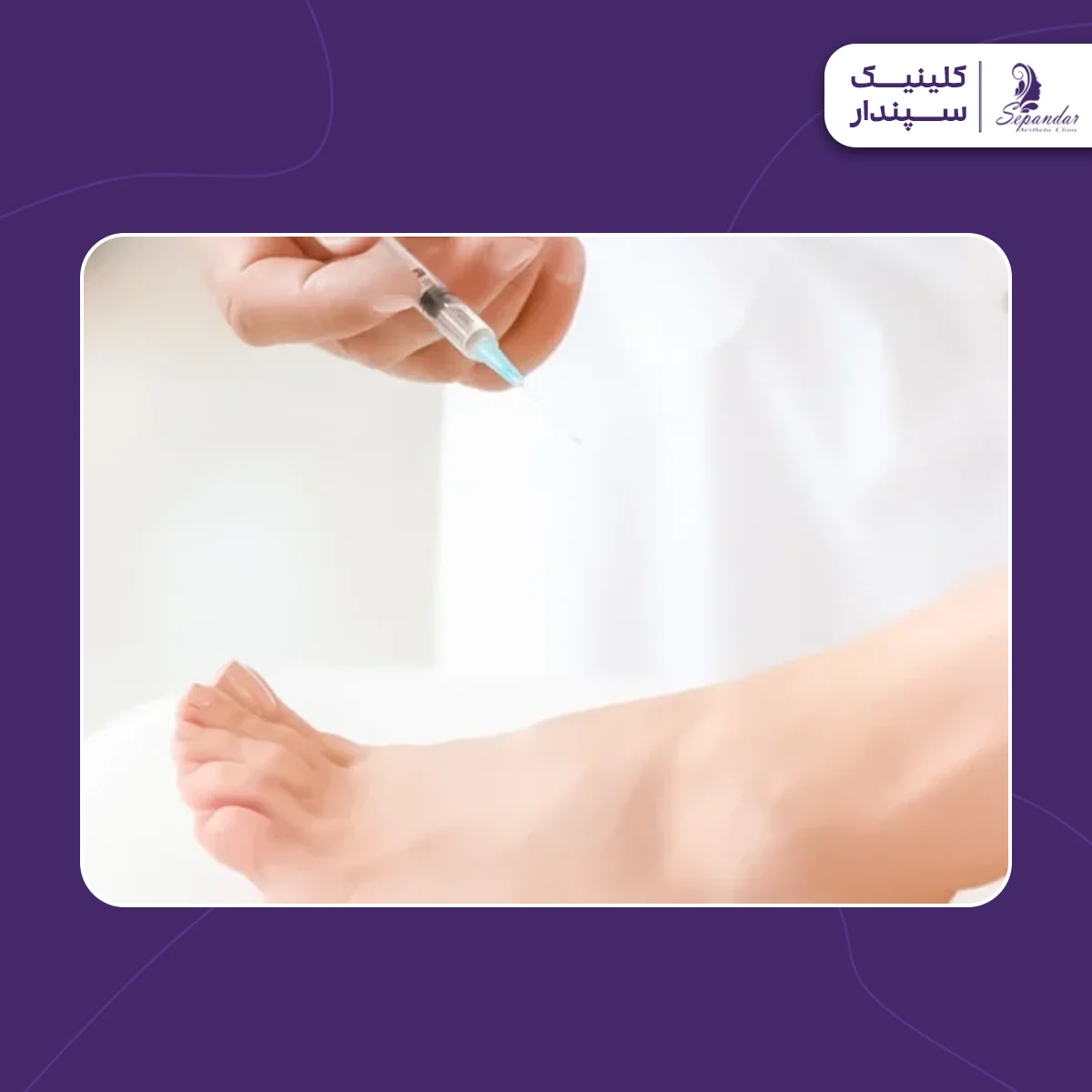 فردی که در حال تزریق بوتاکس کف پا است تا از تعریق بیش از حد کف پا جلوگیری کند