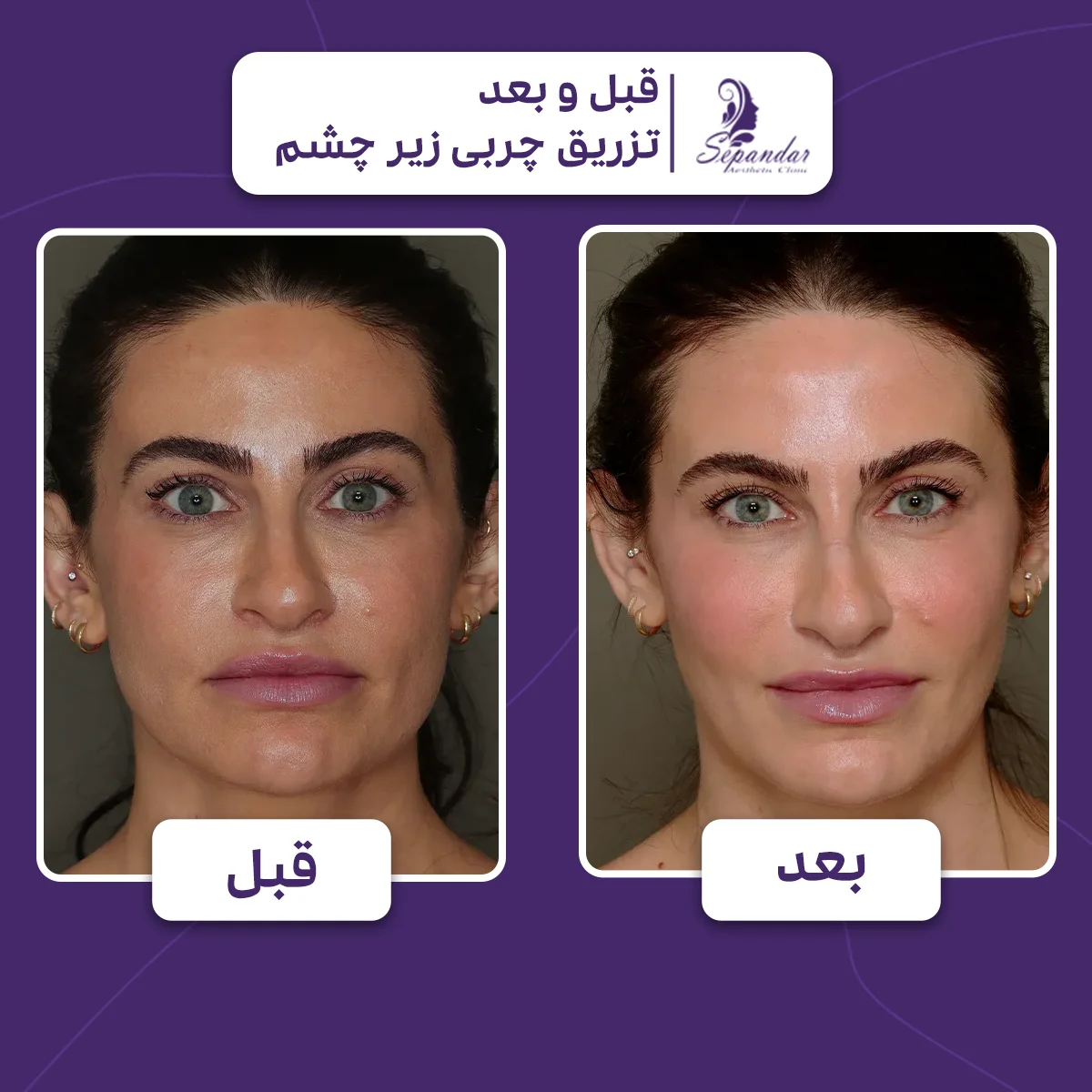 عکس صورت یک خانم قبل و بعد از تزریق چربی زیر چشم که بعد از تزریق تیرگی و گودی زیر چشم بهبود یافته است