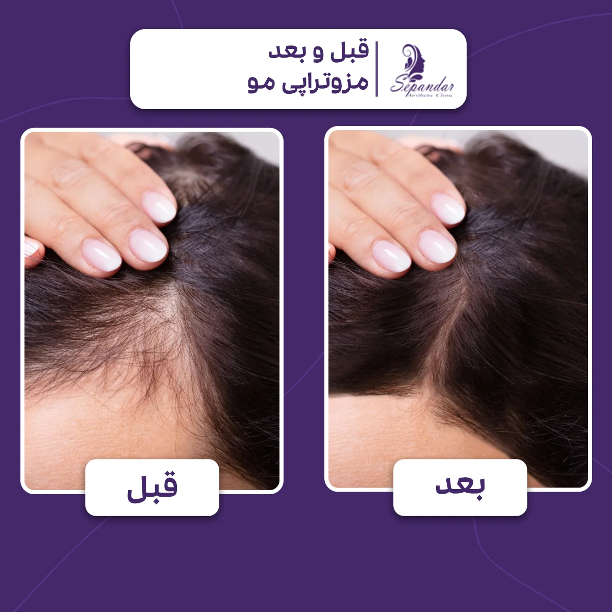 موهای سر یک خانم قبل و بعد از مزوتراپی مو که بعد از انجام مزوتراپی موها پر پشت تر شده است